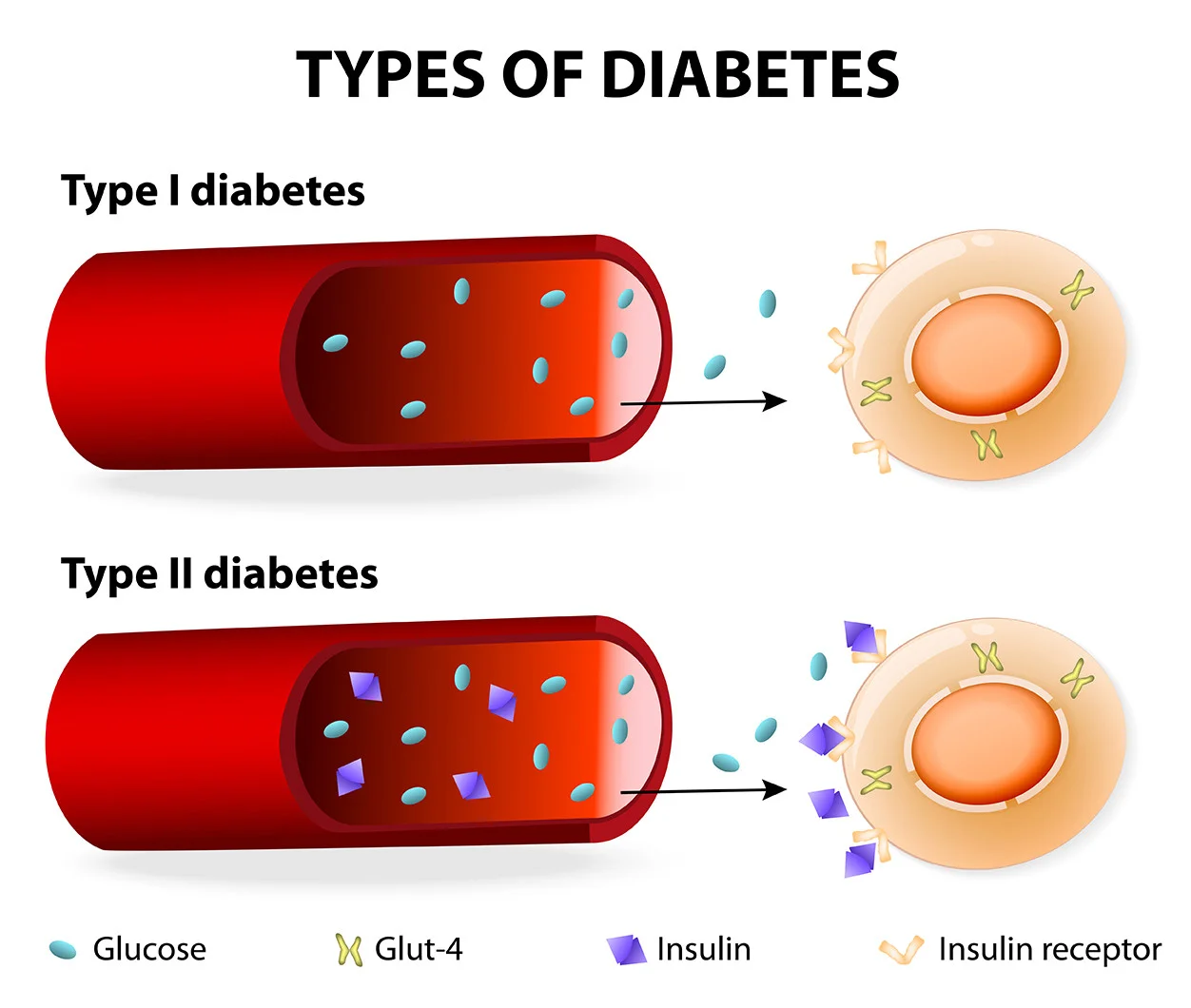 Understanding types of Diabetes Mellitus